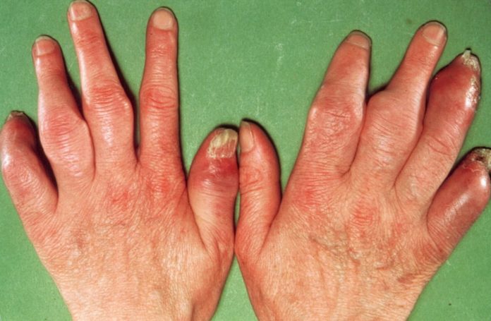 Artrite Psoriática