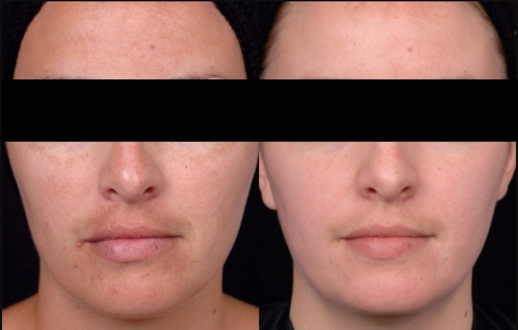 peeling químico antes e depois 01