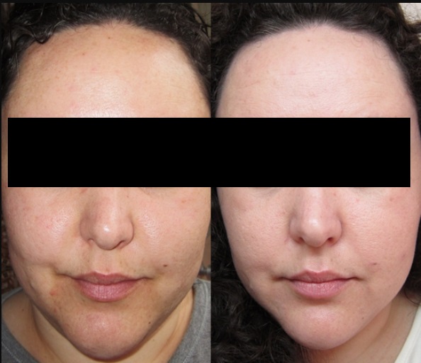 peeling químico antes e depois 02