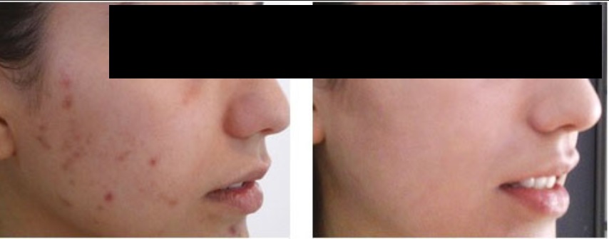 peeling químico antes e depois 03