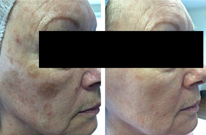 peeling químico antes e depois 04