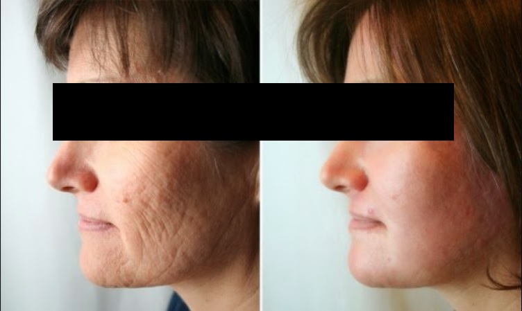 peeling químico antes e depois