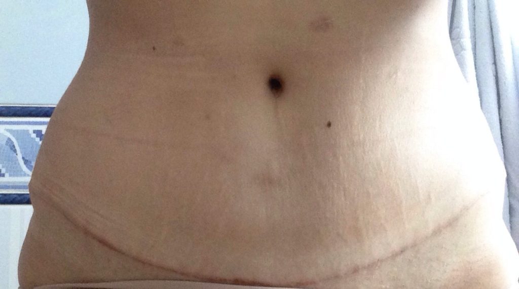 Abdominoplastia