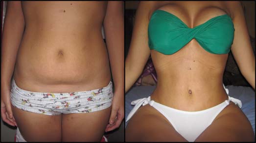 abdominoplastia antes e depois4