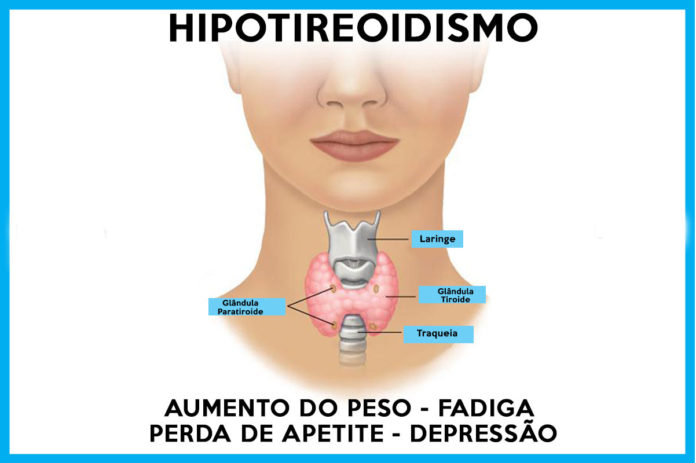 hipotireoidismo