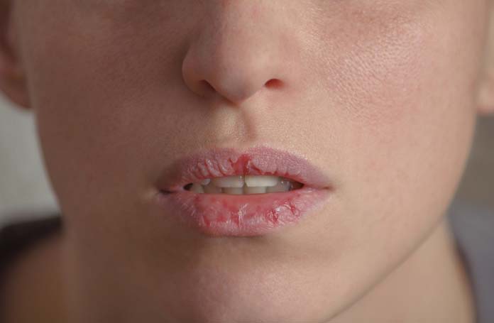 Consequências da desidratação boca e pele secas