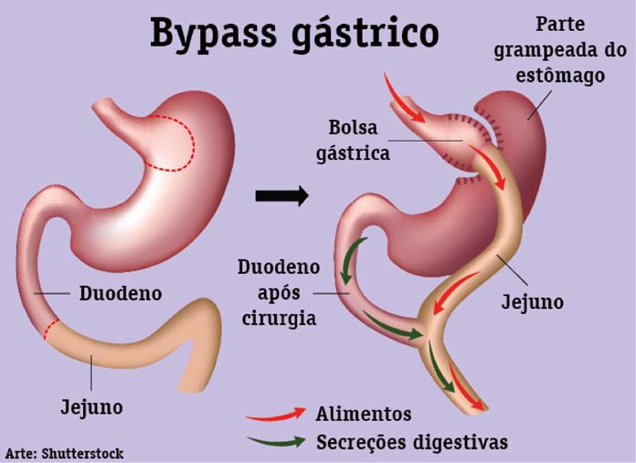 Cirurgia bariátrica com bypass gástrico