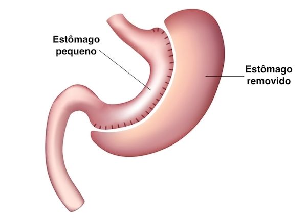 Gastrectomia vertical